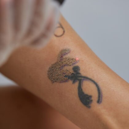 tattoo-removal-treatment