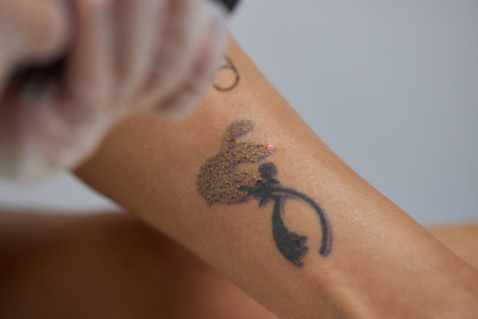 tattoo-removal-treatment